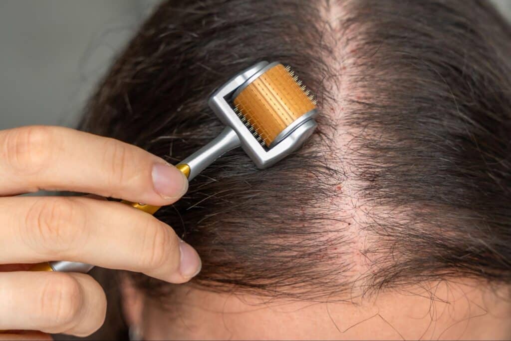 Microneedling therapy enhances scalp health and encourages hair growth effectively.